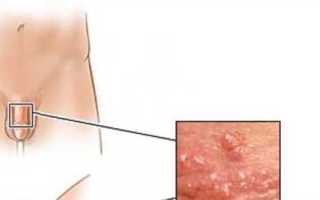 Симптомы ВЧП у женщин