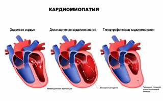 Дисметаболическая кардиомиопатия: причины, симптомы, лечение