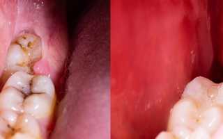 Почему боль в десне не проходит после удаления зуба