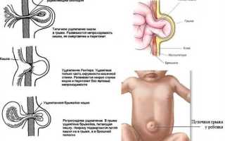 Как справиться с пупочной грыжей у ребенка