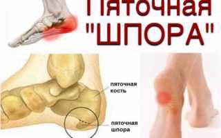 Как лечить пяточные шпоры