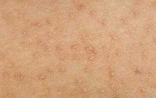 Кожный грибок на теле: причины, симптомы и методы лечения