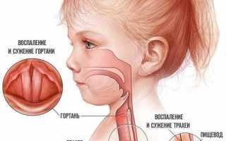 Симптомы трахеоларингита