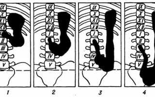 Как лечить опущение желудка