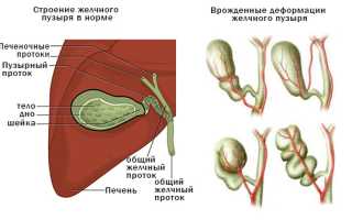 Как лечить перегиб желчного пузыря