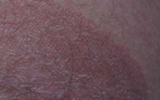 Прыщи на головке почему они появляются