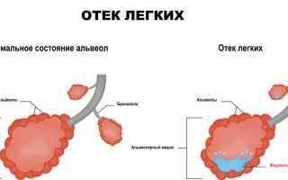 Как лечить отек легких