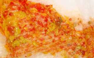 Причины появления крови в кале