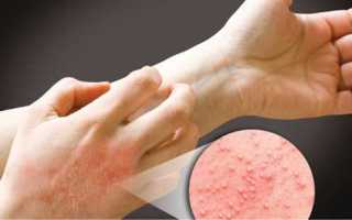 Как избавиться от нейродермита