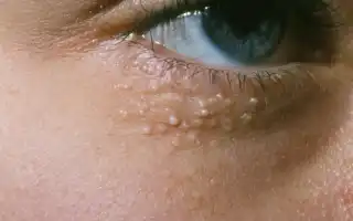 Жировик на глазу – причины, симптомы и методы лечения