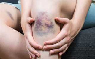 Как избавиться от синяков на теле