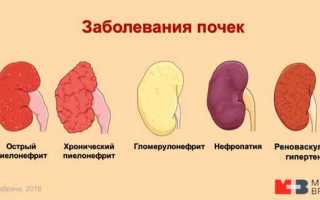 Как лечить больные почки при пиелонефрите