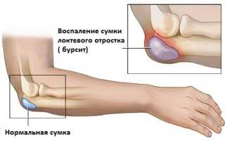 Как лечить ушиб локтя