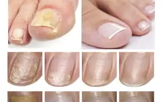 Как вылечить грибок ногтей на ногах