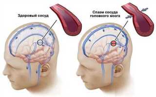 Как лечить сужение сосудов головного мозга