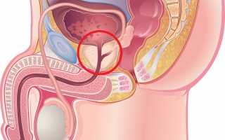Простатит – не беда, вылечим его навсегда!