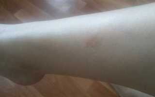 Почему появляются пятна на ногах