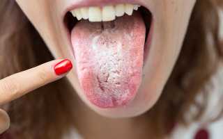 Чем лечить молочницу во рту