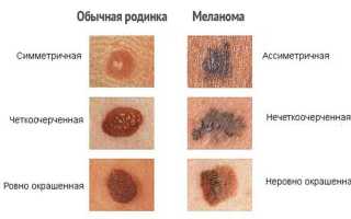 Как определить, если болит родинка