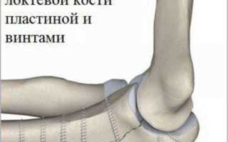 Как лечить перелом локтевого сустава