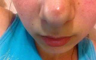 Пора вылечить белые пятна и гнойники на теле