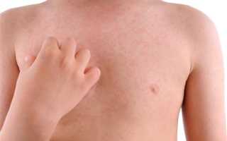 Чем лечить крапивницу