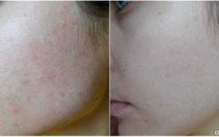 Как избавиться от следов от прыщей