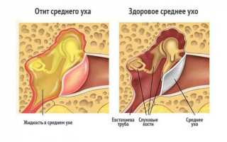 Лечение отита уха