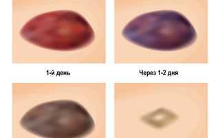 Гематома, причины, симптомы, последствия