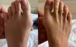 Как избавиться от косточек на ногах