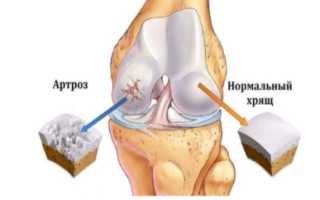 Как лечить артроз коленного сустава