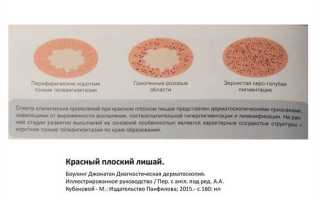 Лечение цветного лишая