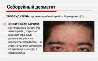 Как лечить себорейный дерматит лица