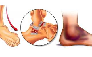 Как лечить вывих голеностопа