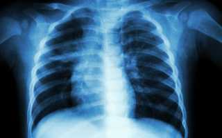 Левосторонняя пневмония у ребенка