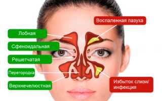 Как лечить ринит
