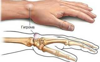 Эффективное лечение гигромы кисти: быстрые методы в борьбе с болезнью
