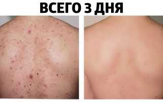 Как избавиться от прыщей на спине в домашних условиях