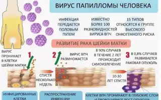 Как избавиться от вируса папилломы человека