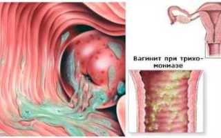 Гинекологические выделения причины диагностика лечение