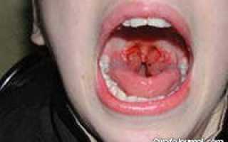 Как вылечить ангину