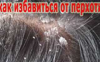 Что делать с перхотью? Как победить перхоть?