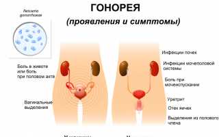 Симптомы гонореи у женщин