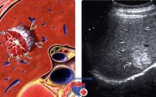 Как лечить гемангиому печени