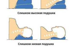Боль при поворотах головы после сна