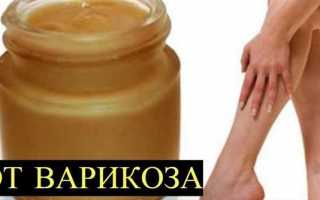 Лечение варикоза в домашних условиях
