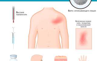 Как лечить опоясывающий лишай