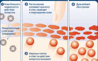 Лечение атопического дерматита