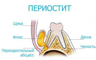 Как лечить периостит