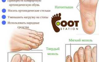 Как лечить мозоли